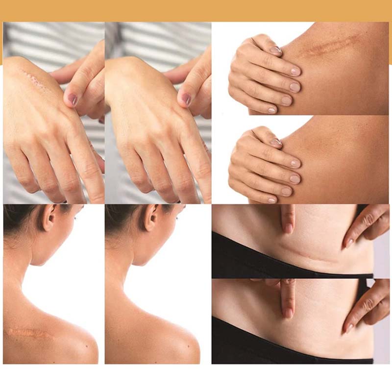 Hjemix | Skin Usynlig Concealer Patch