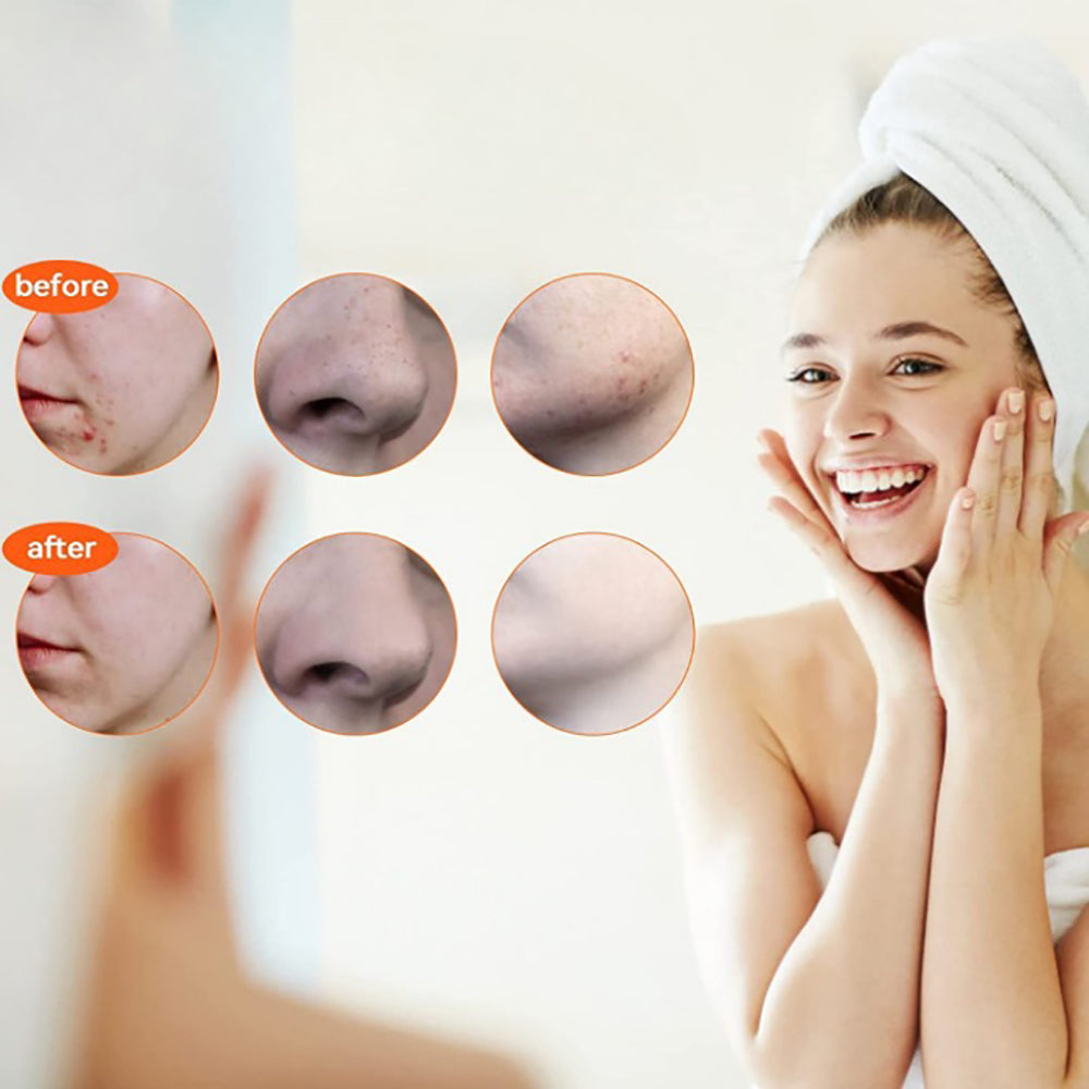 Hjemix | Rustfritt stål blackhead remover pimple popper verktøysett med metallboks