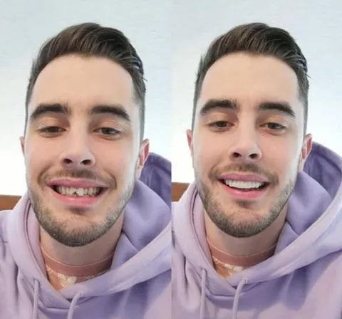 Hjemix | På Smile Veneers (Øvre og Nedre Kjeve inkludert)