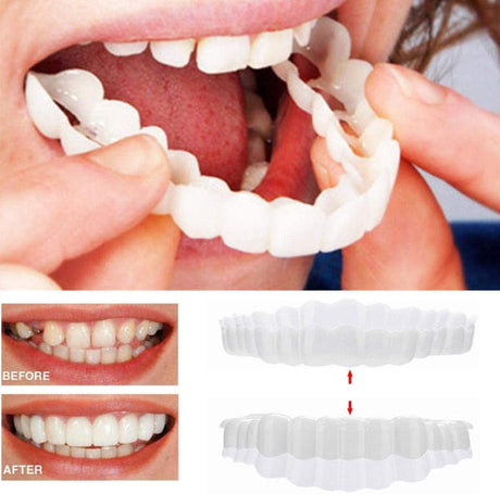 Hjemix | På Smile Veneers (Øvre og Nedre Kjeve inkludert)