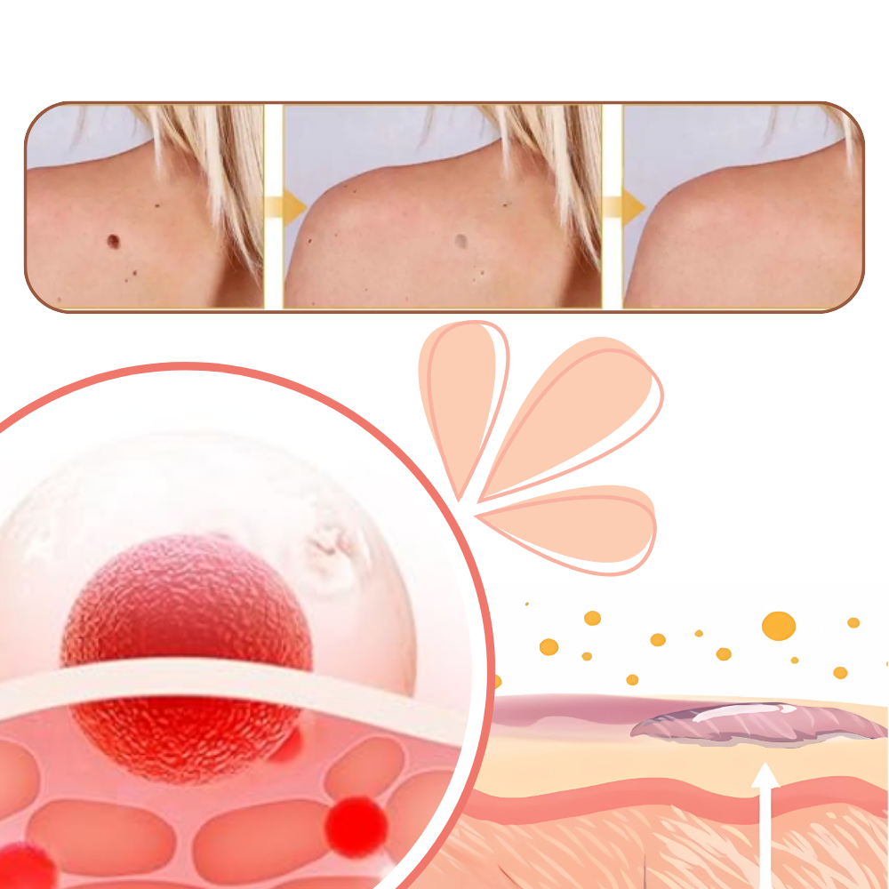 Ikke-Invasiv Fjerning av Merker