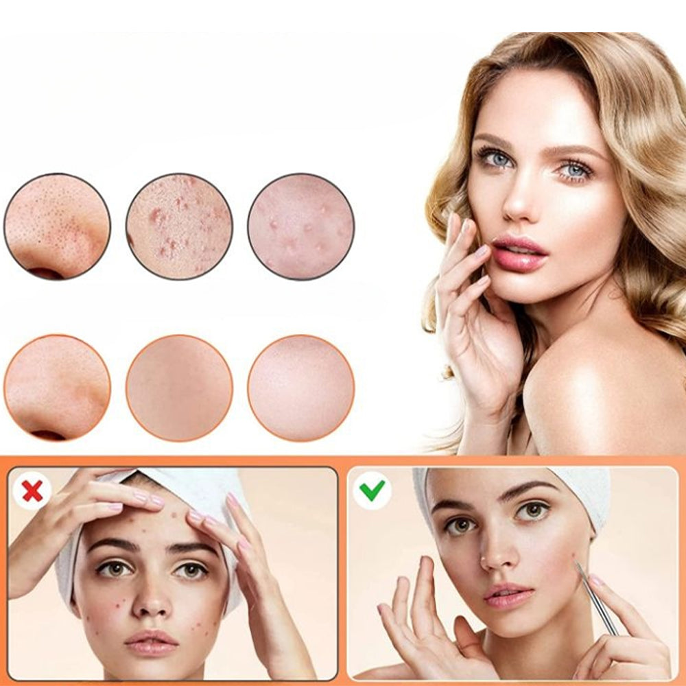 Hjemix | Rustfritt stål blackhead remover pimple popper verktøysett med metallboks