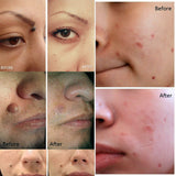 Hjemix | Tag Fjerner Penn, Mole og Vortefjerning