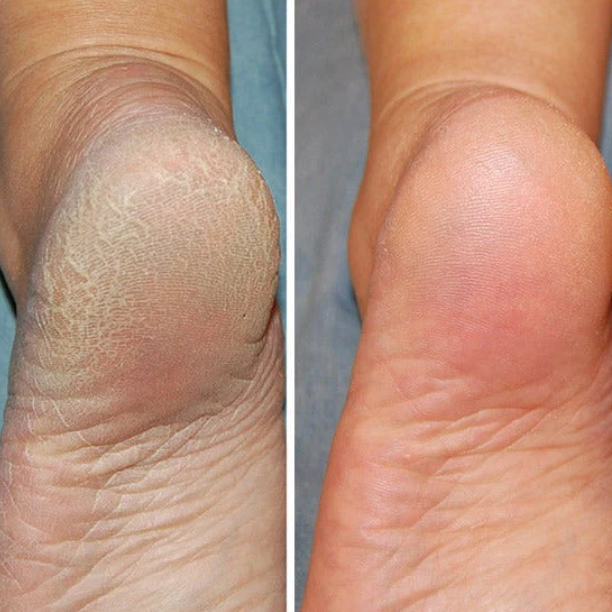 Hjemix | Silicon-Spa-Sokker - Intensivpleie for sprukne og trøtte føtter