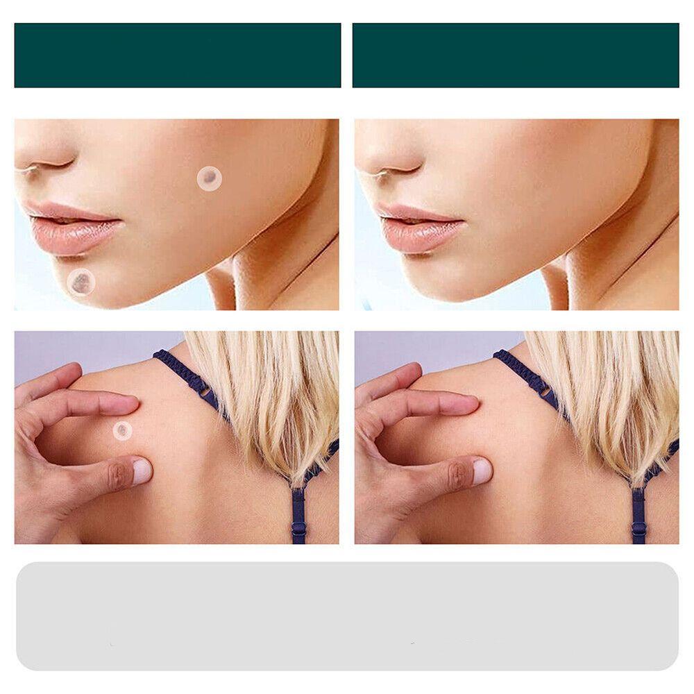 Hjemix | SkinClear - Plaster for the removal of spots and warts