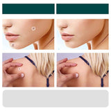 Hjemix | SkinClear - Plaster for the removal of spots and warts