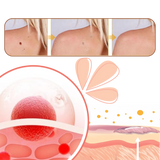 Ikke-Invasiv Fjerning av Merker