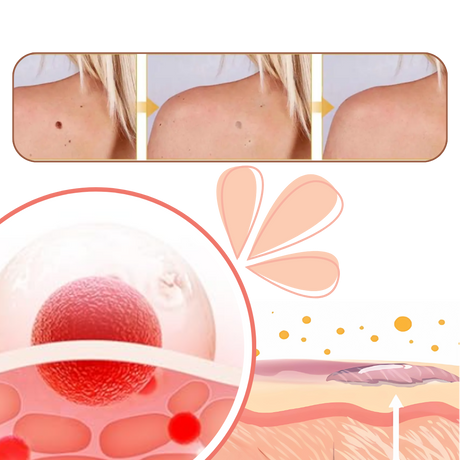 Ikke-Invasiv Fjerning av Merker